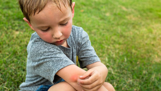 Mozzie-Repellent-Kid-Bitten
